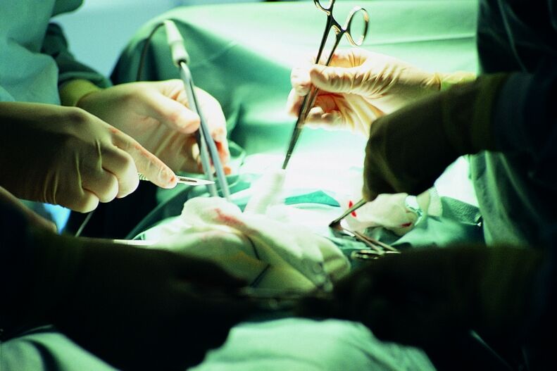 kirurško povećanje debljine penisa